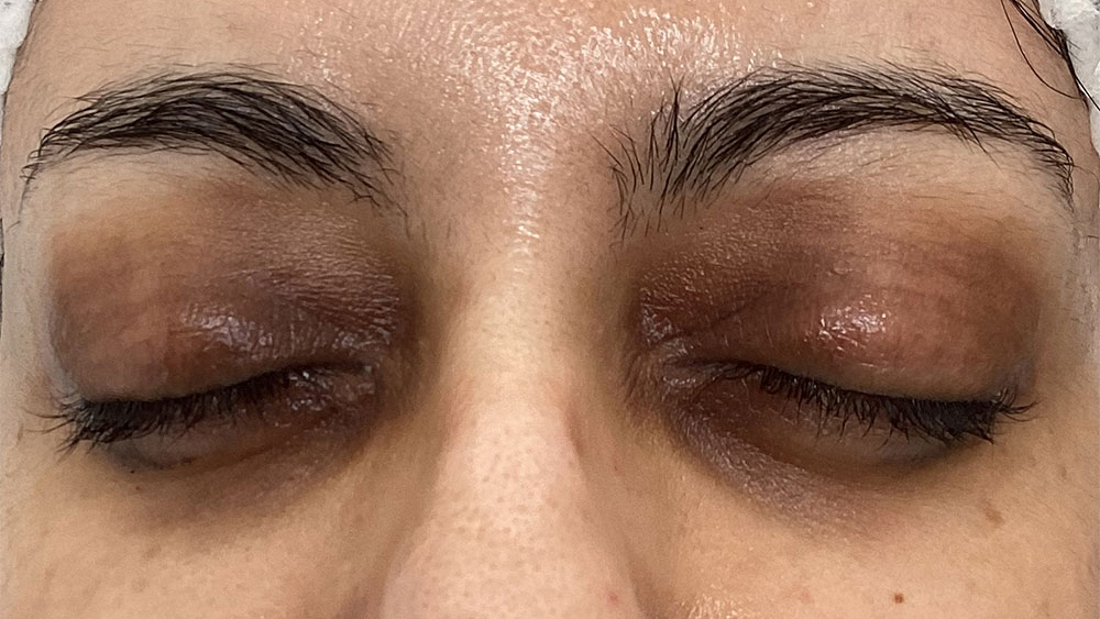 NanoSoft Eye Before